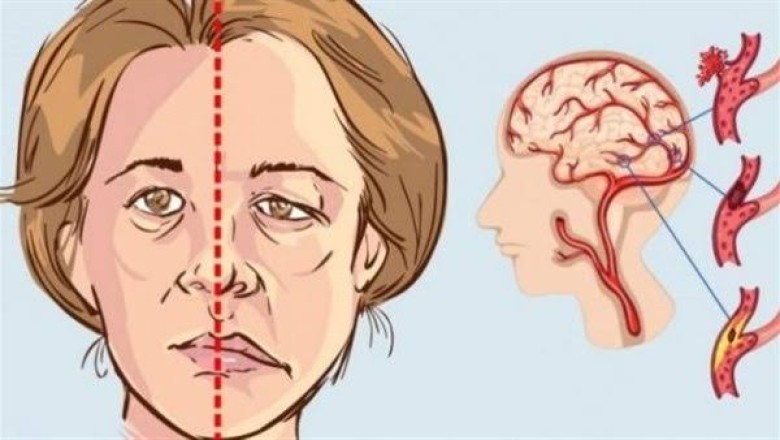 السكتة الدماغية عند النساء أعراضها واسبابها